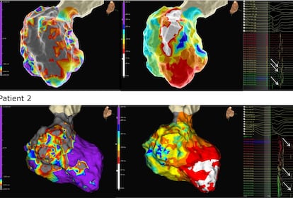 Corazones virtuales de dos pacientes construidos por el equipo de Trayanova en la Universidad Johns Hopkins (Estados Unidos).