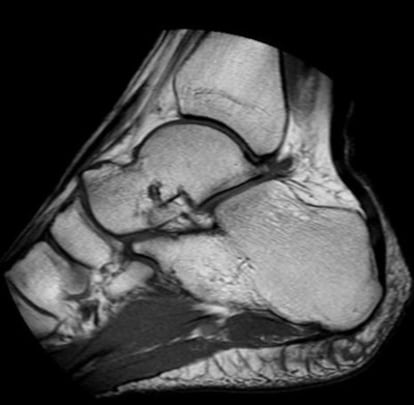 Imagen de un tobillo obtenida por una maquina de resonancia magnética para extremidades.