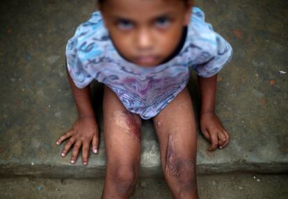 Mohammed Riyas, un niño refugiado rohingya de 5 años, en la Escuela Primaria Seagull en el campamento de refugiados de Kutupalong en Cox's Bazar, Bangladés. Los militares prendieron fuego en su casa, lo que le causó cicatrices en las piernas.