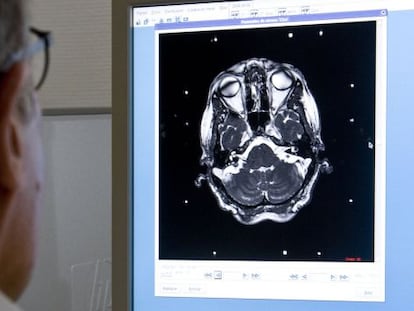 Un especialista examina un escáner cerebral.