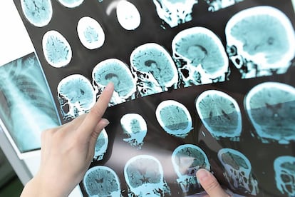 Cerebro de un paciente con alzhéimer.