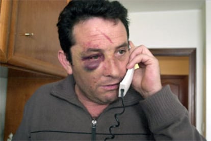 Antonio Morales, tras ser agredido por un juvenil y sus familiares hace unos días.