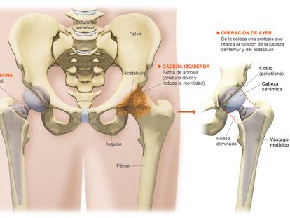 Operación de cadera del Rey