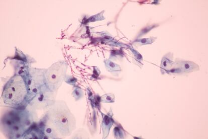 <p>Conocida comúnmente como hongos vaginales, la candidiasis la produce el hongo <em>candida albicans</em> y <strong>no se considera estrictamente una infección de transmisión sexual</strong>. En cuanto al agente que lo causa, esta experta señala que "la mujer se puede contaminar del hongo que vive en su tubo digestivo", sobre todo en "casos de bajada de defensas o cambios en la flora vaginal natural". Algo que puede ocurrir en situaciones tan corrientes como la toma de antibióticos.</p> <p>Para curarla <a href="https://www.cdc.gov/std/tg2015/candidiasis.htm" rel="nofollow" target="_blank">lo más efectivo son los fármacos azólicos</a> (pomadas u óvulos), aclaran desde el Centro para el Control y la Prevención de Enfermedades de Estados Unidos (CDC por sus siglas en inglés), que <strong>se usarán durante unos tres días</strong>. "Si una mujer la padece hay que tratar también a la pareja, pues lo pueden compartir", explica Herrero.</p>