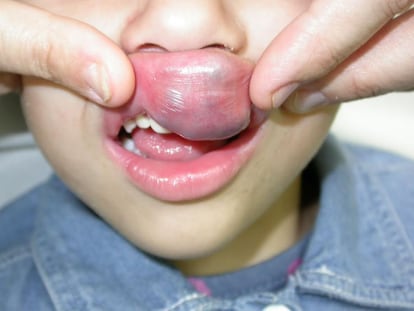 Un niño con malformaciones vasculares