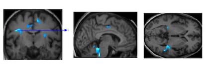 Cerebro de una persona mayor de 65 años sana. En azul, las regiones que se activan durante la labor de memorización visual. Las personas sanas con mayores reservas cognitivas activan menos regiones porque necesitan menos recursos.
Por el contrario, las personas mayores con alzhéimer o algún tipo de deterioro cognitivo que han cultivado reservas presentan una mayor activación, ya que pueden compensar las pérdidas físicas ligadas a la enfermedad.