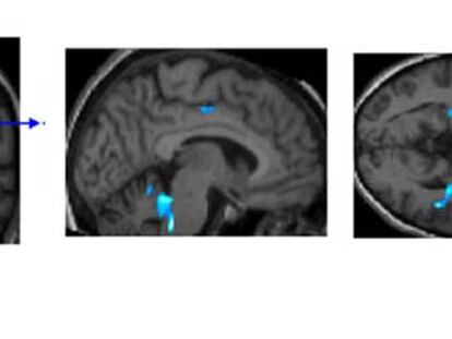 Cerebro de una persona mayor de 65 años sana. En azul, las regiones que se activan durante la labor de memorización visual. Las personas sanas con mayores reservas cognitivas activan menos regiones porque necesitan menos recursos.
Por el contrario, las personas mayores con alzhéimer o algún tipo de deterioro cognitivo que han cultivado reservas presentan una mayor activación, ya que pueden compensar las pérdidas físicas ligadas a la enfermedad.