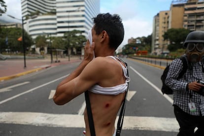 Un manifestante muestra heridas en su cuerpo durante una protesta contra el Gobierno del presidente de Venezuela, Nicolás Maduro.