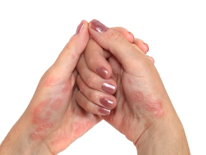 Psoriasis Hand