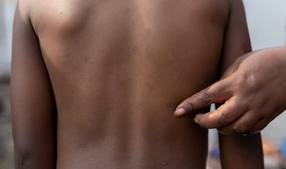 Una mujer mostraba las marcas causadas por la mpox en la espalda de su hijo, el 18 de julio en Nyiragongo, cerca de Goma, en la provincia de Kivu Norte (República Democrática de Congo).
