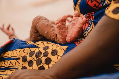 Aline (not her real name), a one-month-old baby, with her mother in the mpox isolation unit at Kamanyola hospital in the Democratic Republic of Congo on July 24.