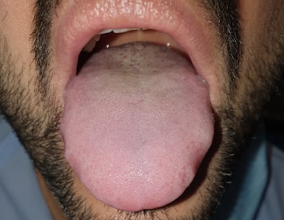 The tongue of a Covid-19 patient.