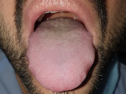 La lengua agrandada y con las marcas de los dientes en los laterales de un paciente con covid.