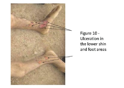 Úlceras en la parte inferior de la espinilla y en los pies de un cadáver.