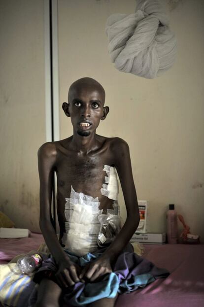 Un paciente sentado en una de una sala del Hospital Madina en Mogadiscio, Somalia. Imagen facilitada por la African Union-United Nations Information Support Team.