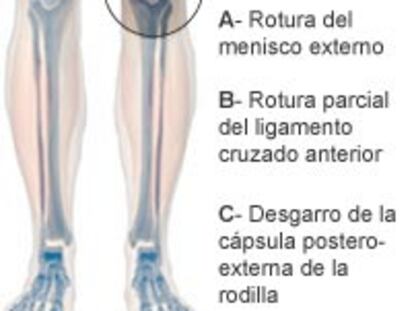 Lesión de Raúl