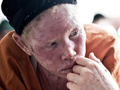 Astou Sarr es presidenta de la asociación local de albinos Anpras en Pikine (Senegal).