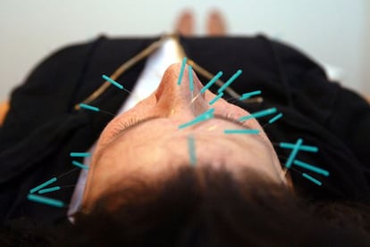 Una mujer durante una sesión de acupuntura.