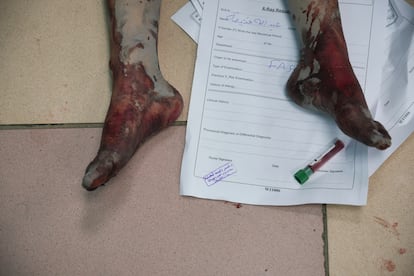 Un palestino herido en un bombardeo israelí espera a ser atendido en el hospital de Deir al Balah, en el centro de la Franja.