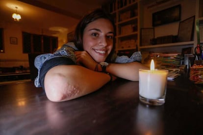 Chloé vive con la psoriasis desde pequeña.