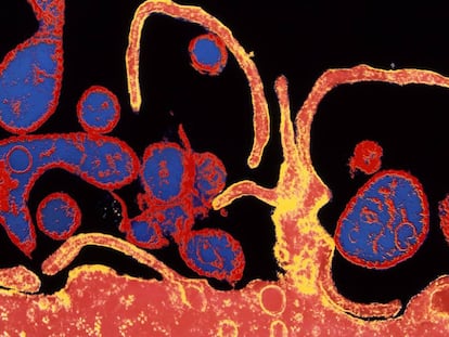 Microtograf&iacute;a electr&oacute;nica coloreada del virus de sarampi&oacute;n infectando una c&eacute;lula.