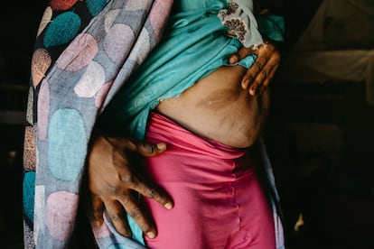 "Me golpearon brutalmente", dice Samira (nombre ficticio) una sudanesa de 45 años, mientras recuerda la noche en que los soldados asaltaron su casa en la zona de Al Fasher. "Nos atacaron porque yo era empresaria. Importaba coches de Benín, y mi casa fue el primer objetivo. Fui gravemente torturada", agrega. La historia de Samira no es un caso aislado. La propia mujer explica que en regiones como Darfur y Kordofán del Norte, los grupos armados suelen elegir a las mujeres que tienen independencia económica o pertenecen a determinados grupos étnicos.
En la imagen, la mujer muestra las secuelas de las agresiones sufridas en su precaria vivienda en el campo de Adré, en Chad, en septiembre de 2023.