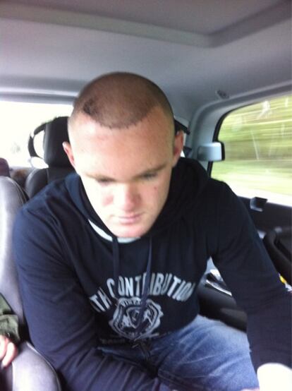 Imagen del trasplante de Wayne Rooney, que él mismo ha colgado en su cuenta de Twitter.