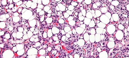 Un tejido con liposarcoma. Los c&iacute;rculos blancos son los ac&uacute;mulos de grasa.