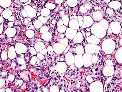 Un tejido con liposarcoma. Los c&iacute;rculos blancos son los ac&uacute;mulos de grasa.