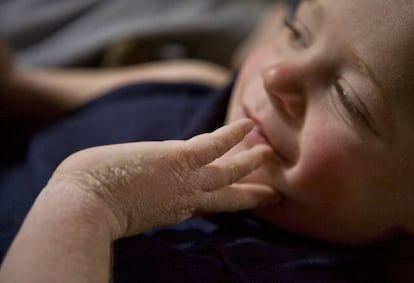 Niño con ictiosis.