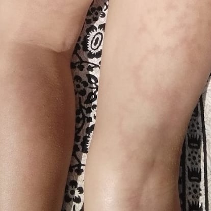Lesiones livido reticularis lividez en red). /AEDV