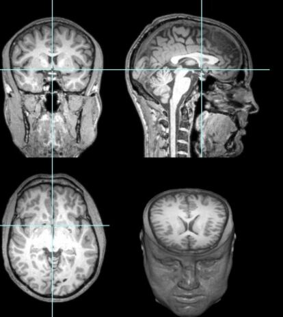 El estudio del cerebro de Garéyev mostró conexiones extraordinarias entre distintas partes