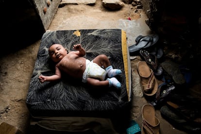El bebé Ahee Bom yace sobre un cojín en el pasillo de su casa en Zanzíbar, Tanzania, el pasado febrero. Después del nacimiento, la piel de Ahee comenzó a oscurecerse y despegarse en grandes tiras. El curandero tradicional Bi Mwanahija Mzee lo bañó con dos exfoliantes hechos de hojas.
