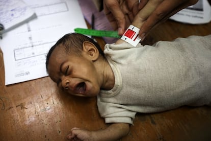 Una niña palestina que sufre desnutrición es medida mientras recibe tratamiento en el Hospital de la Asociación de Amigos de los Pacientes en la ciudad de Gaza, este martes.