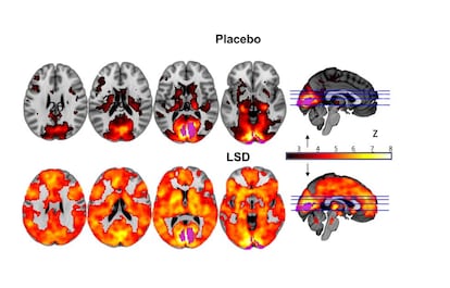 La imagen muestra como, con los ojos cerrados, intervienen muchas más áreas del cerebro en la experiencia visual bajo los efectos del LSD (abajo) que con el placebo.