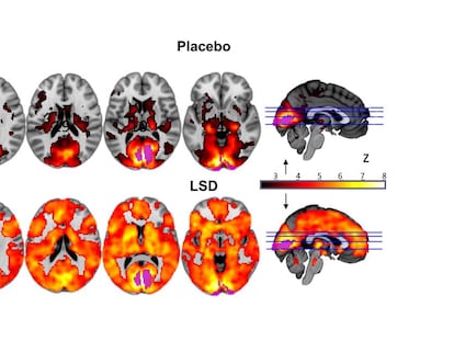 La imagen muestra como, con los ojos cerrados, intervienen muchas más áreas del cerebro en la experiencia visual bajo los efectos del LSD (abajo) que con el placebo.