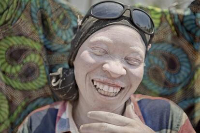 Saltos, canciones, risas… infancia. Me tenían loca con el “pikcha! pikcha!” (¡hazme una foto!). Epafroida vive en Kabanga, un refugio de albinos cercano al l lago Tanganica. El Gobierno tanzano se ha visto obligado a crear centros especiales para proteger a las personas con albinismo que tienen que huir de sus poblados. Temen ser descuartizadas por los traficantes de cuerpos que venden sus miembros a hechiceros para la elaboración sus preciadas pócimas de buena suerte. Sin embargo, el verdadero asesino al que se enfrentan cada día es el sol, que consume sus vidas provocándoles cáncer de piel antes de los 30 años si no se protegen adecuadamente.