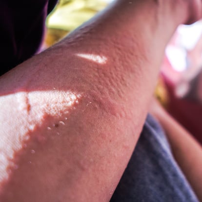 Allergies cause rashes on men's skin