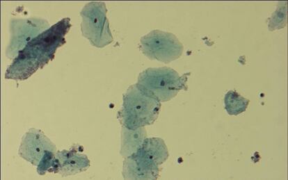 Vista al microscopio de la bacteria 'Gardnerella vaginalis', causante de infecciones en la vagina
