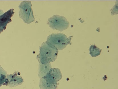 Vista al microscopio de la bacteria 'Gardnerella vaginalis', causante de infecciones en la vagina