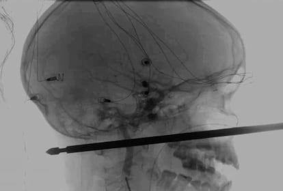 Radiografía de la cabeza de Xavier Cunningham con la broqueta atravesada.