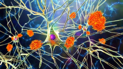 Ilustración de placas de amiloide de la enfermedad de alzhéimer en neuronas.