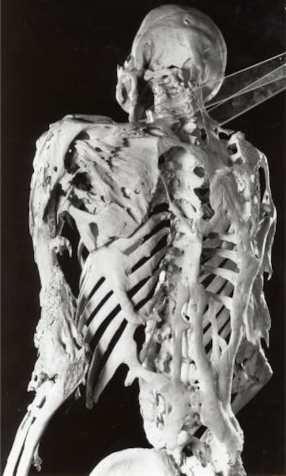 Vista posterior del esqueleto de Eastlack, con muchos huesos fusionados
