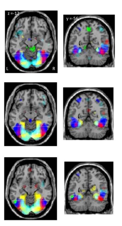 Imágenes de resonancia funcional del cerebro de personas analfabetas y alfabetizadas en edad adulta y en edad infantil, de arriba abajo, durante los experimentos