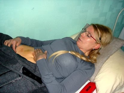 Imagen distribuida la semana pasada de la ex primera ministra ucraniana Yulia Timoshenko, que muestra sus heridas en la prisión ucraniana de Járkov.