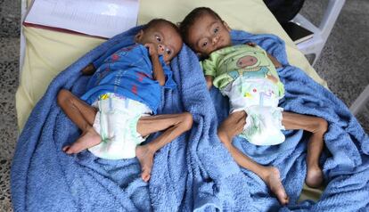 Anas y Taibah, gemelos, ingresaron en el hospital de Abs afectados de malnutrición, anemia y diarrea agua.