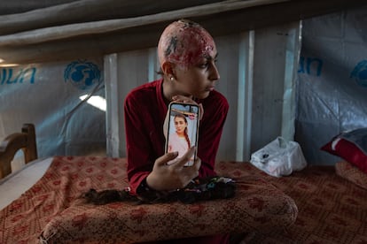 Hala Abu Dahlez, una niña palestina de 12 años, muestra una foto suya tomada antes de la lesión que le produjo un columpio metálico que se desplomó sobre ella tras un ataque aéreo israelí, en Al-Mawasi, Jan Yunis, en el sur de la franja de Gaza, ayer.