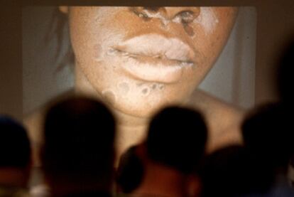 Imágenes de los efectos de una enfermedad de transmisión sexual en una clase en Nueva York.