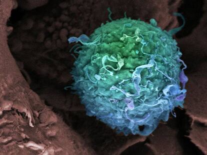 Uma célula de câncer de mama.