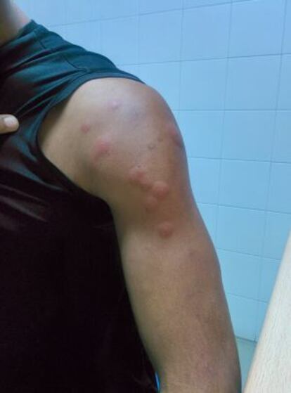 Picaduras en el brazo de uno de los internos del CIE de Valencia.